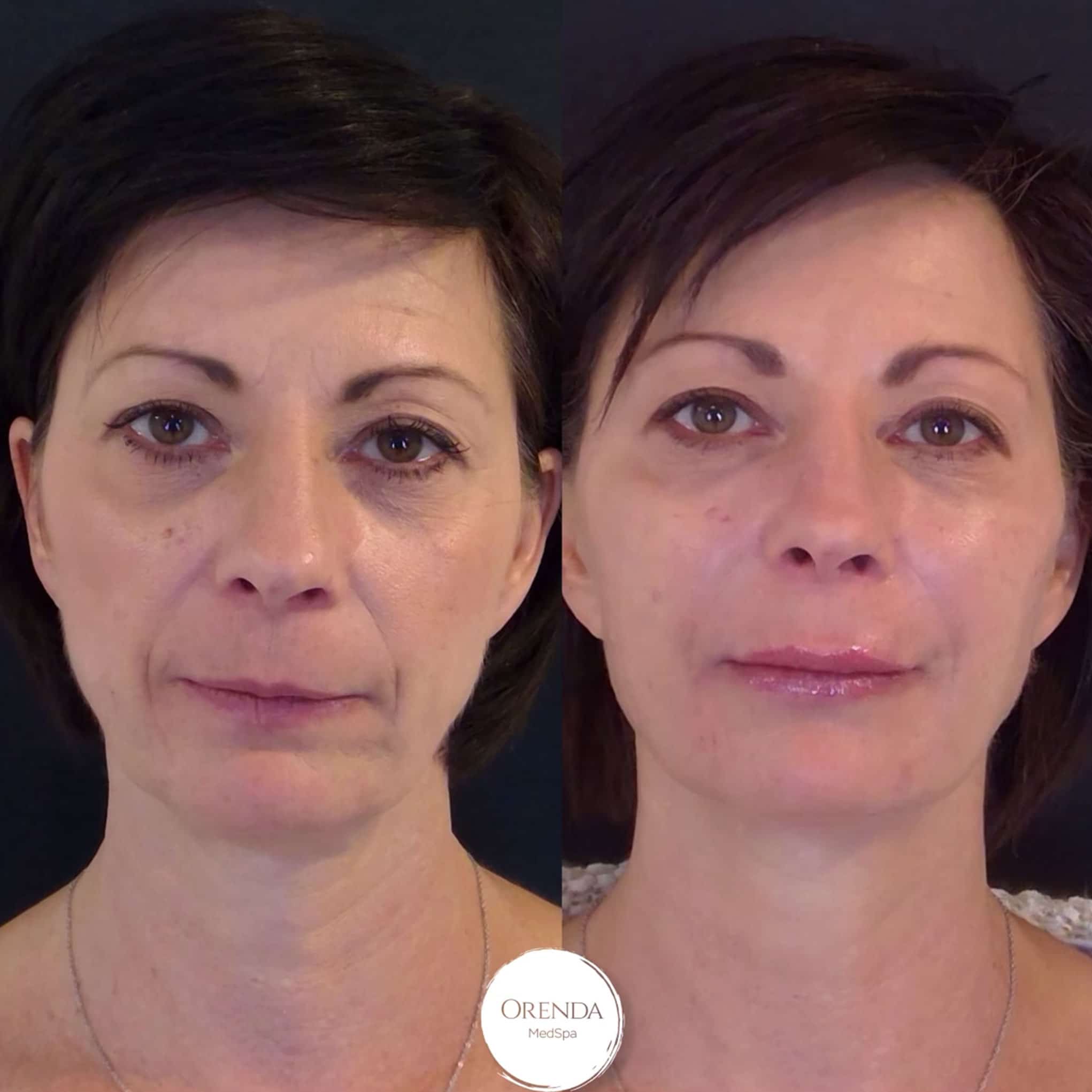 Non-surgical Face Lift before and after