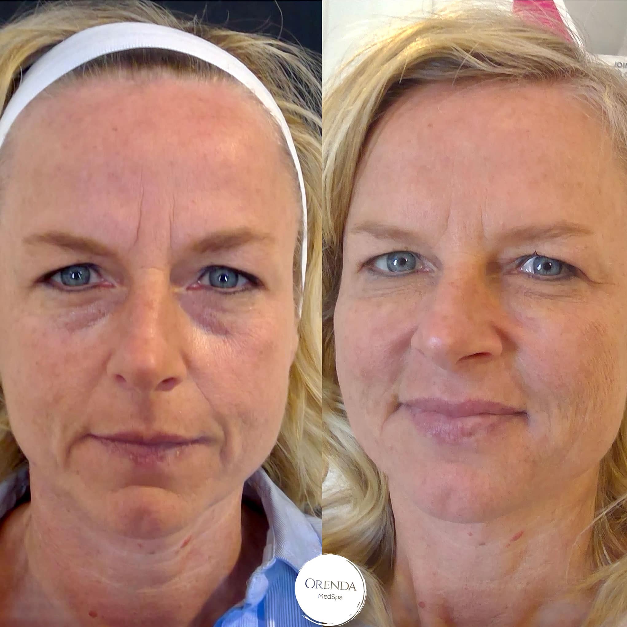 Non-surgical Face Lift before and after