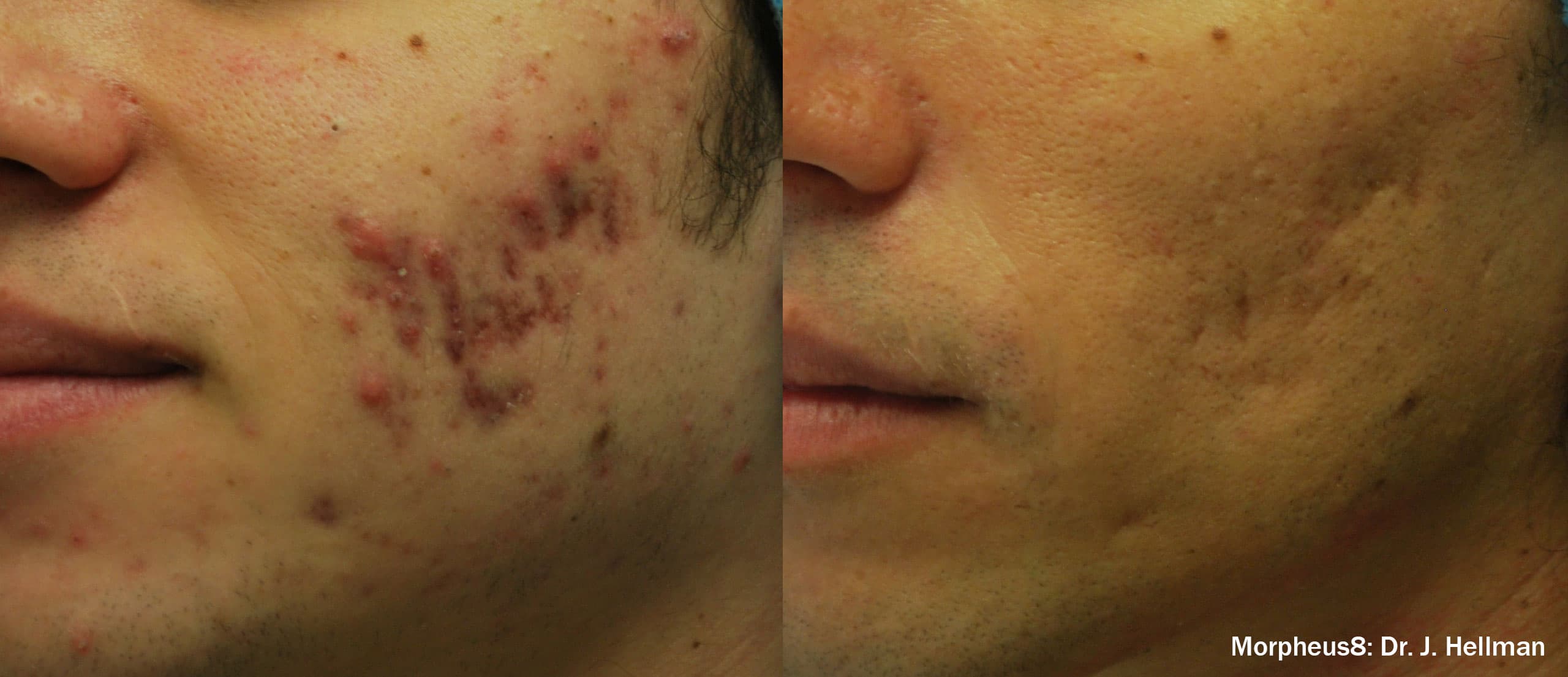 acne scar treatment before and after