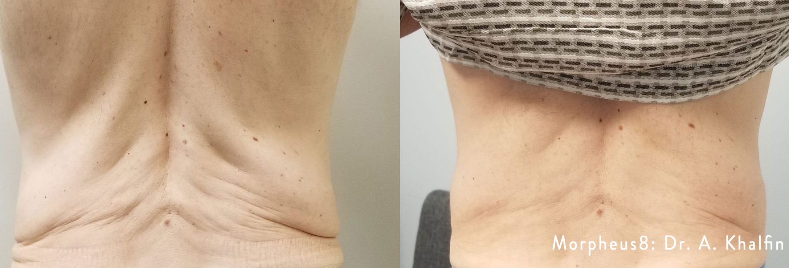fat reduction before and after