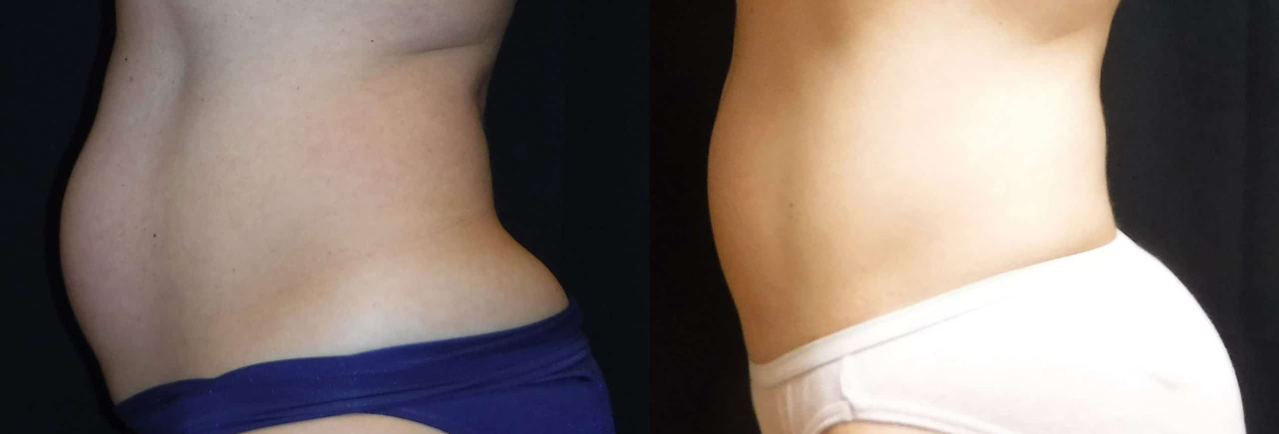 fat reduction before and after