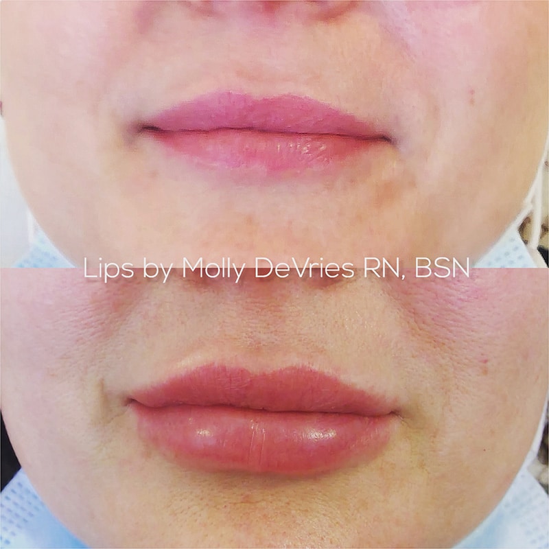 Lip Injection Before and After