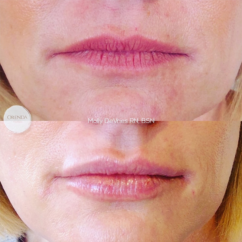 Lip Injection Before and After