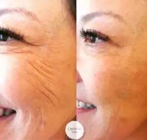 Radial Cheek Lines treatment in Castle Rock