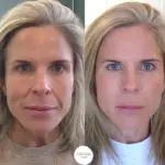 Smile Lines Treatment in Castle Rock