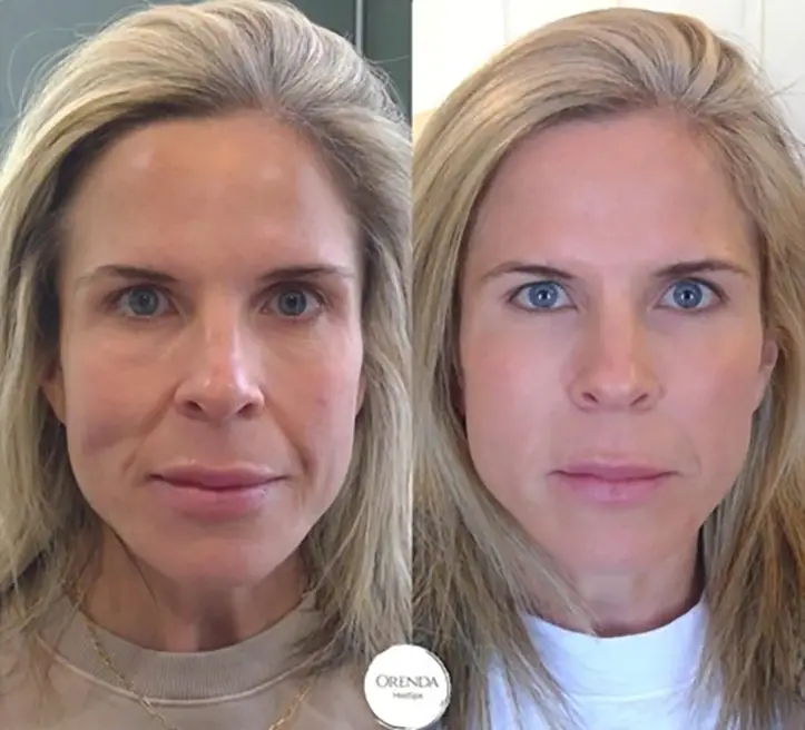 Smile Lines Treatment in Castle Rock