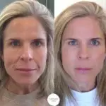 Smile-lines-treatment-Nasolabial-Folds