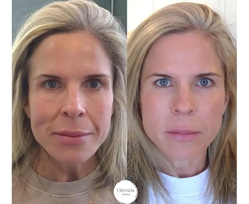 Smile-lines-treatment-Nasolabial-Folds