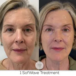 1st Sofwave Treatment Female