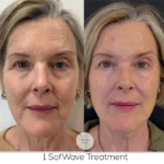 Sofwave Treatment