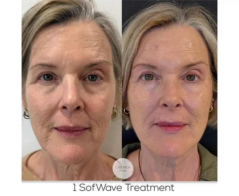 Sofwave Treatment