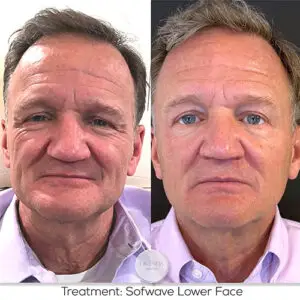 1st Sofwave Treatment Male