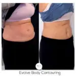 Evolve Body Contouring