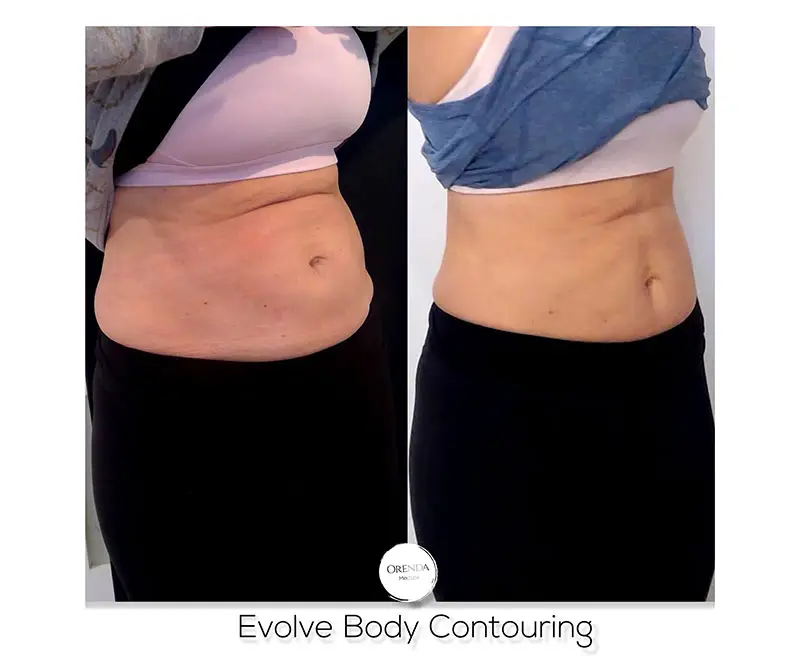 Evolve Body Contouring