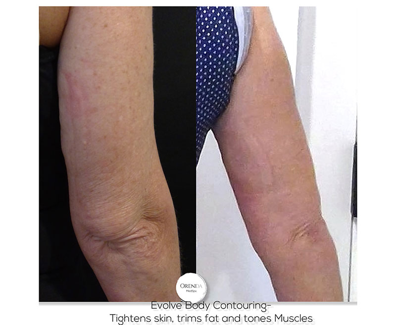 Evolve Body Contouring Tightens Skin, Trims Fat and Tones Muscles