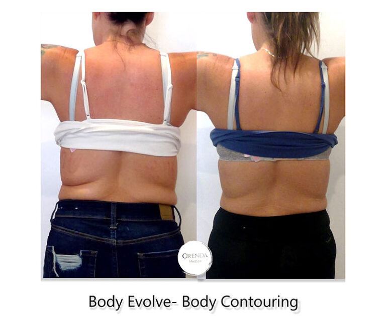 Evolve Body Contouring Tightens Skin, Trims Fat and Tones Muscles