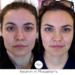 Masseter Botox before and after photos