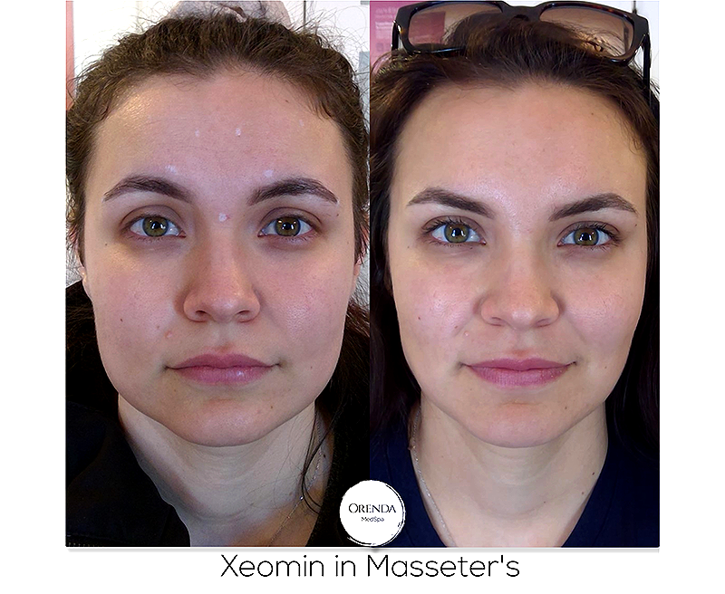 Masseter Botox before and after photos