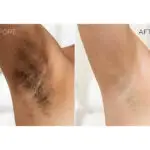 Why are my uderarms dark image